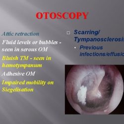 Acute otitis media soap note