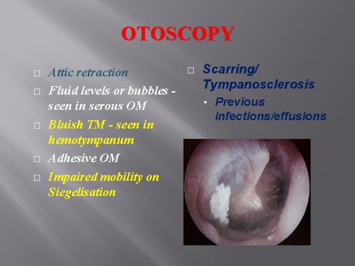 Acute otitis media soap note