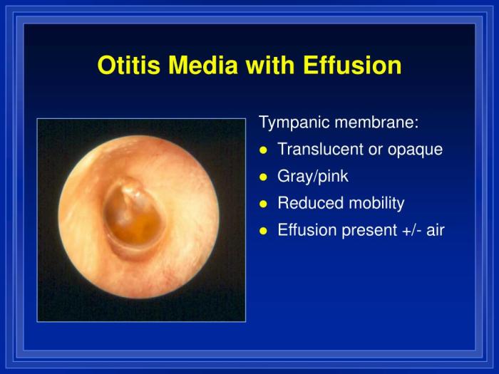 Acute otitis media soap note